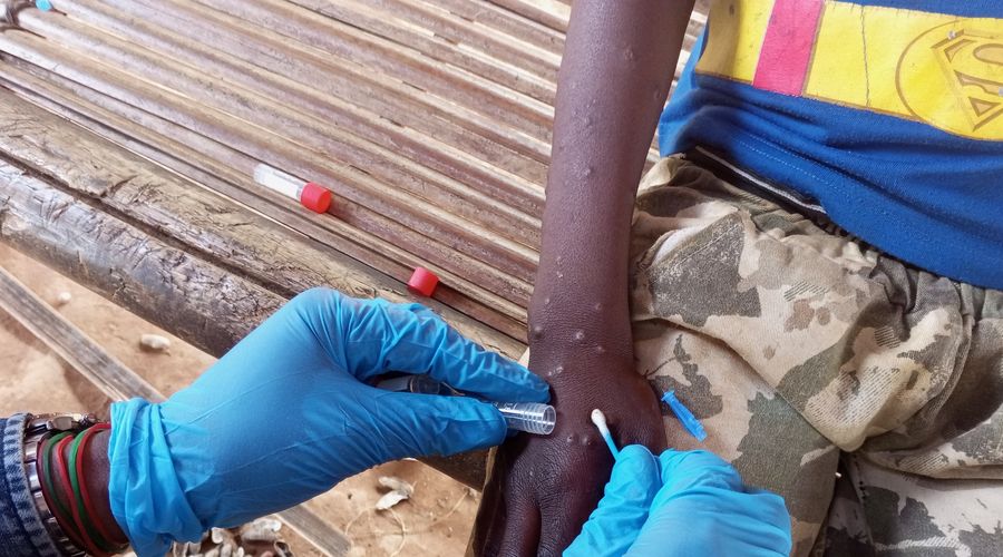 Gana’da ‘maymun çiçeği’ alarmı… Vaka sayısı 583’e yükseldi Gana’da ‘maymun çiçeği’ alarmı… Vaka sayısı 583’e yükseldi